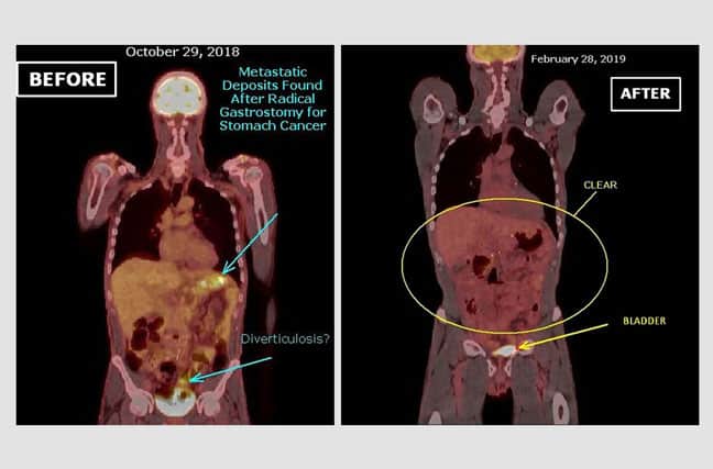 ¿Qué puede esperar un paciente con múltiples metástasis en pulmones, hígado, cerebro o huesos?